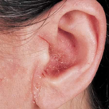 dermatita seboreica urechi