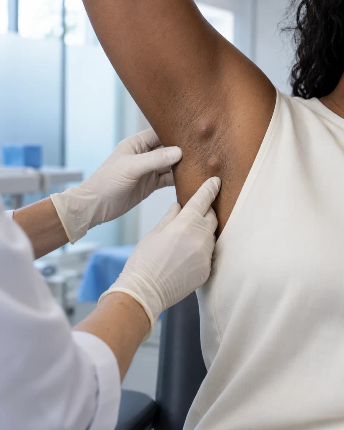 Examinarea dermatologică a unor noduli recurenți în zona axilei