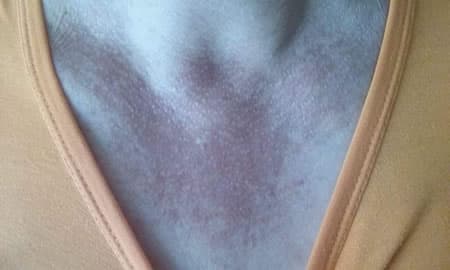 poikilodermia civatte