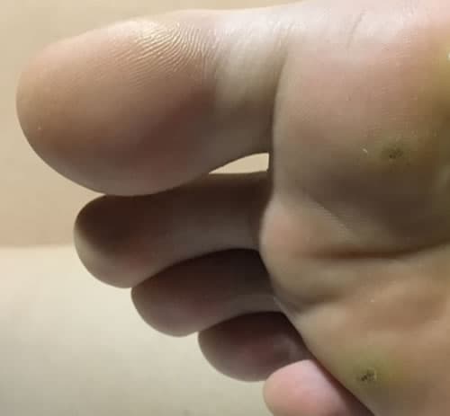 Fotografie de veruci plantare din arhiva Derma Online