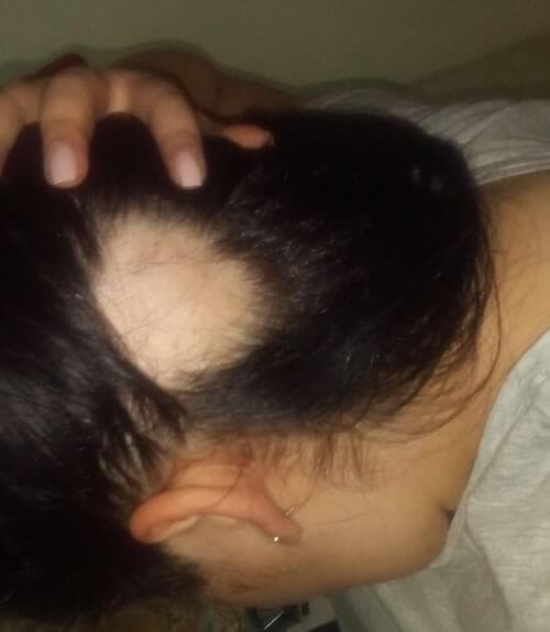 Zonă de cădere localizată a părului, din articolul despre alopecie areată