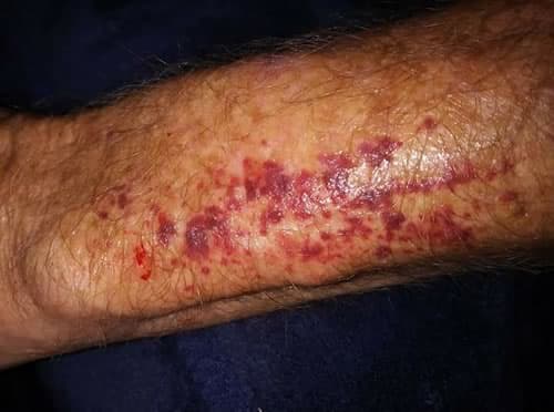 purpura