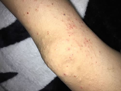 dermatoza perforanta