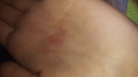 Fotografia originală a unei palme din articolul Eczema dishidrotica
