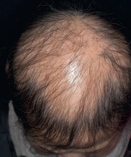 Rărirea părului pe scalp, fotografie din arhiva Derma Online despre alopecie