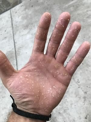 keratoliza exfoliativa