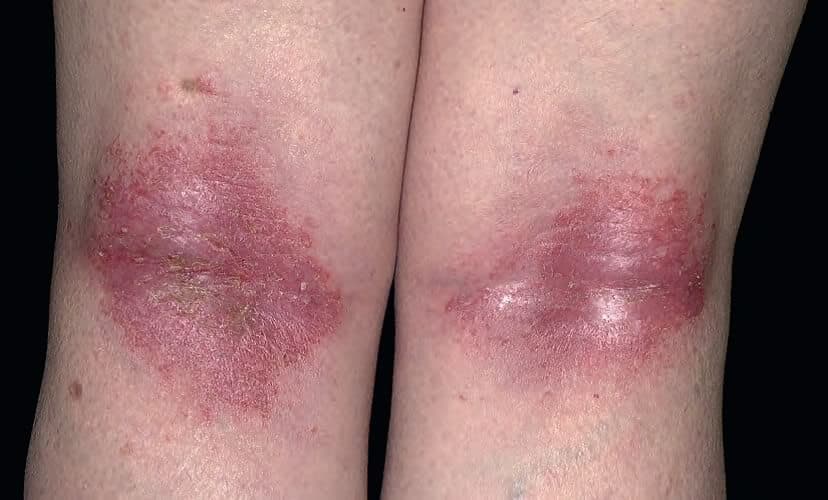 Fotografia originală din articolul Dermatita Atopică: două zone inflamate ale pielii