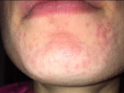 dermatita periorala