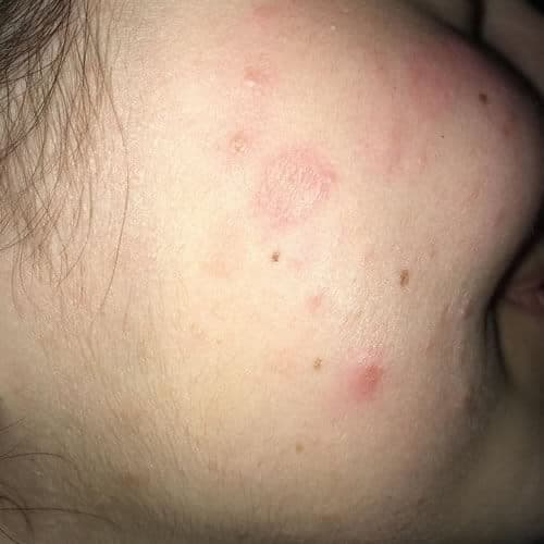 impetigo