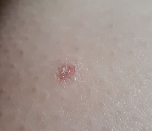 psoriazis vulgar