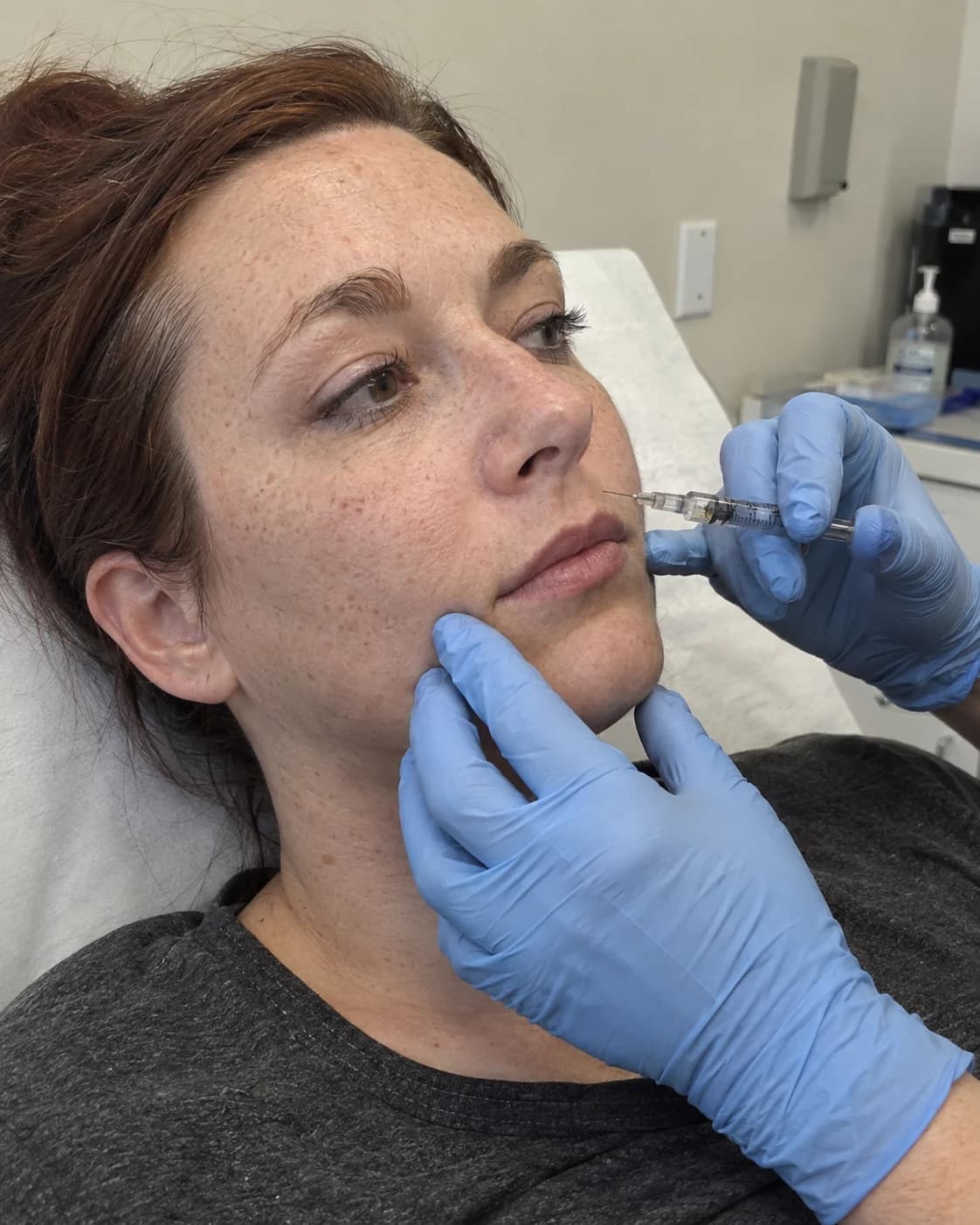 Imagine ilustrativă generată: pregătirea injectării de acid hialuronic la conturul buzelor