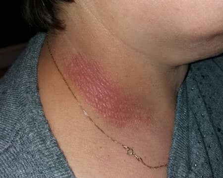 iritatie piele