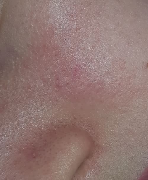 roseata pe fata