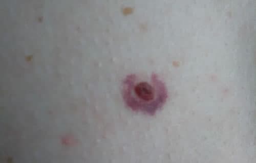 alunita maligna