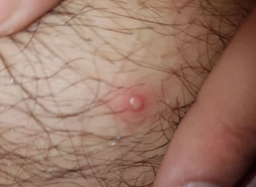 molluscum contagiosum