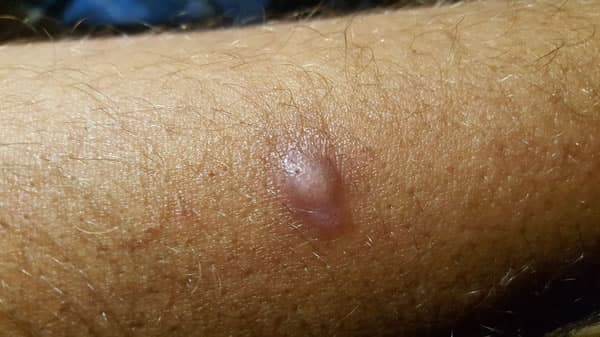 vezicula