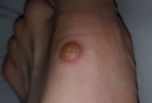 keratoacantom