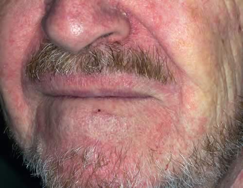 dermatita seboreica fata