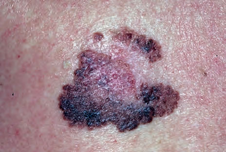 Melanomul extensiv