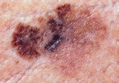 melanomul