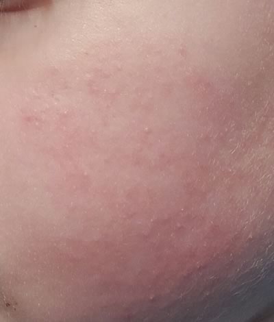 Dermatita Atopica