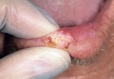 carcinom spinocelular
