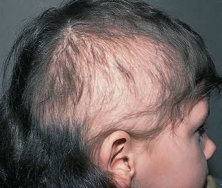 trichotillomania