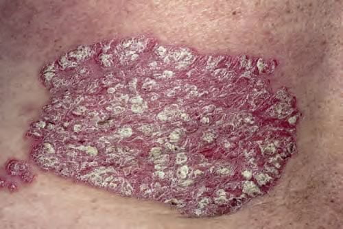 Psoriazis