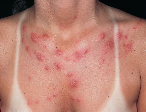 Urticarie Solara