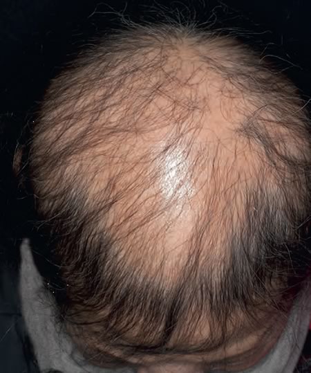 alopecia androgenetica