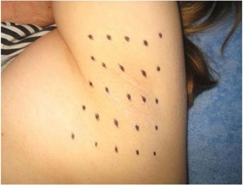 Injectare toxina botulinica