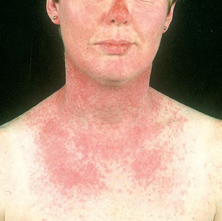 Alergia Solara