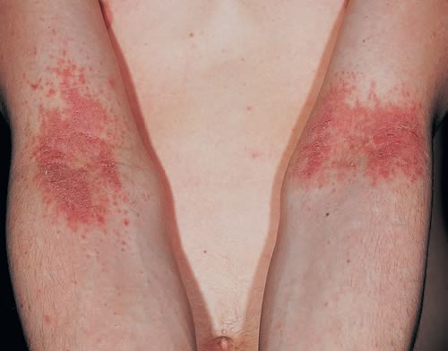Eczema Atopica Copilarie