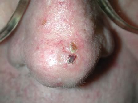 carcinom bazocelular