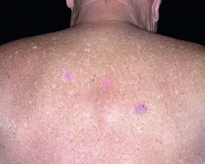 carcinoame bazale superficiale