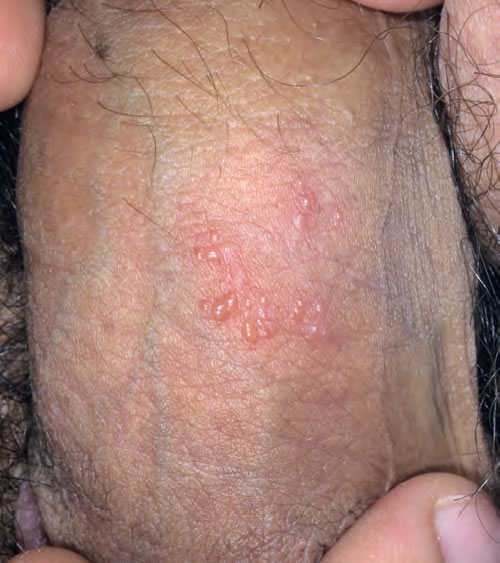 herpesul genital