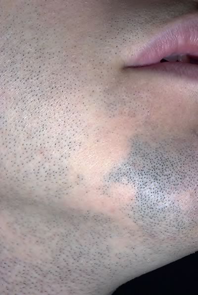 alopecia areata