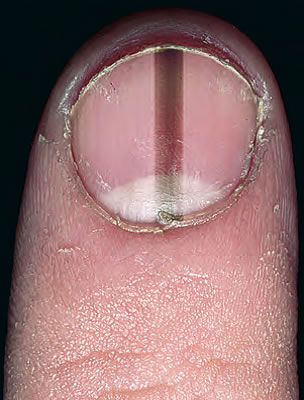 melanom acral