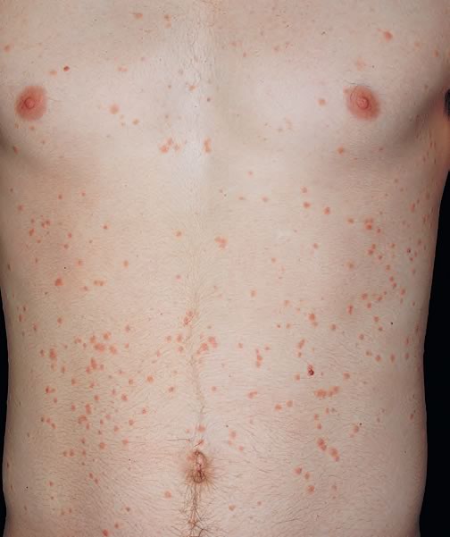 Psoriazis al Scalpului