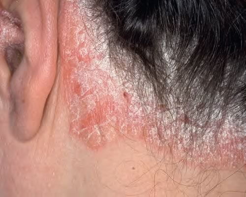 Psoriazis al Scalpului