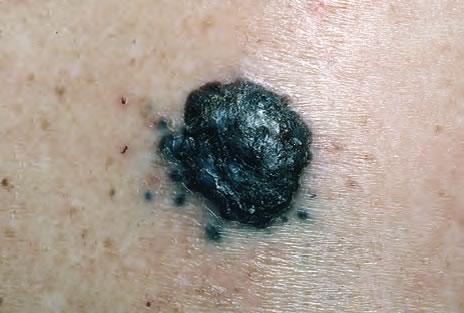 Melanom Nodular
