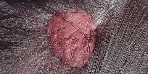 Nev Dermal Scalp