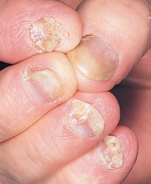 Psoriazis Unghii