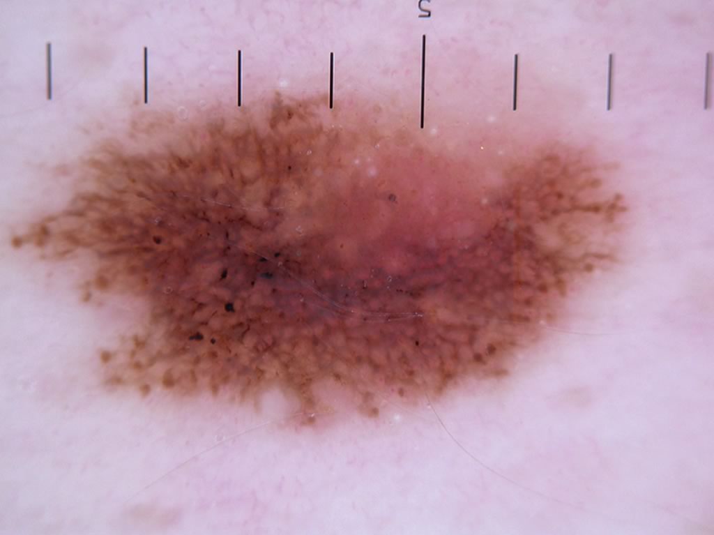 Imagine Dermatoscopica Alunite