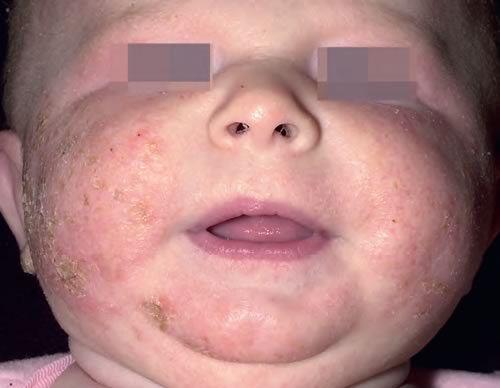 Dermatita Atopica Sugar