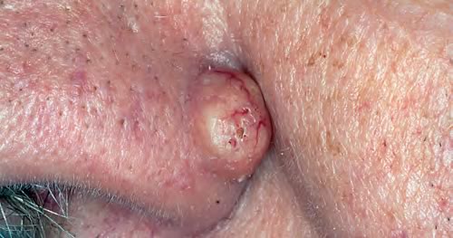Nev Dermal