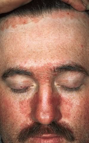 Dermatita Seboreica Scalp