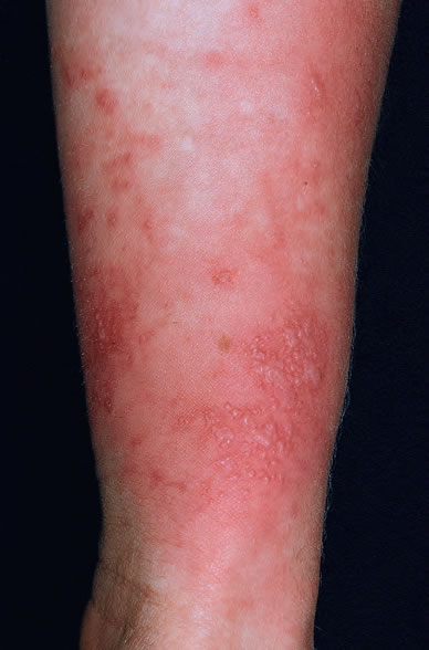 Fitofotodermatozele