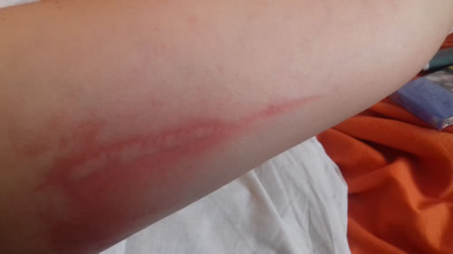 fitofotodermatoza