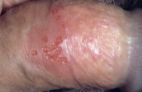 virus herpes simplex2